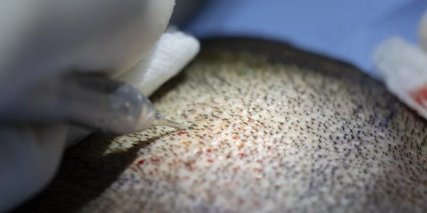 Implant de par DHI