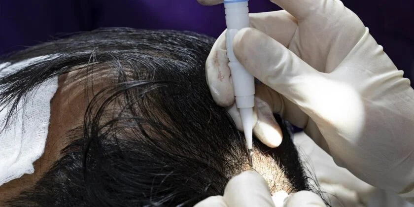 Cat costa un implant de par in Bucuresti?